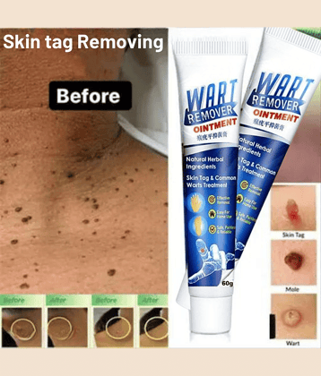 Wart Removal Ointment Treatment for Remove Warts Moles & Acne Safely Painless