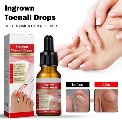 Ingrown Toenail Softening & Care Drops | Nail Softener & Foot Hygiene Solution | Helps Reduce Discomfort, Prevents Inflammation, Disinfects & Supports Nail Health (100Ml)