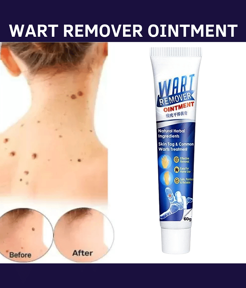 Massa Wart Remover Cream For Skin For Wart Free Skin For Men Or Women