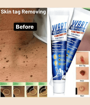 Wart Removal Ointment Treatment for Remove Warts Moles & Acne Safely Painless