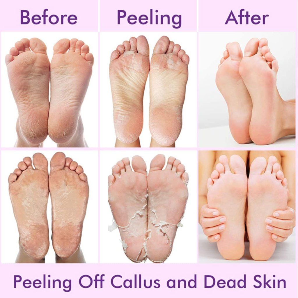 WUGO:: Deep Moisturising Foot Peeling Mask for Cracked Feet | Dead Skin Remover | Make Your Feet Baby Soft |Lavender | Exfoliate Foot Crack Socks|with Lavender Remove Dead Skin|Get Result Soft Feet in 5-7 Days (Medically Original Peeling Mask-1 Pair)