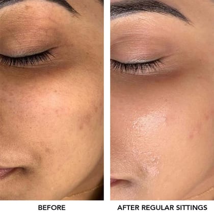 O3+ Meladerm Vitamin C Gel Bleach For Dullness Removal, Hydration & Glowing Skin, All Skin Types (96g)
