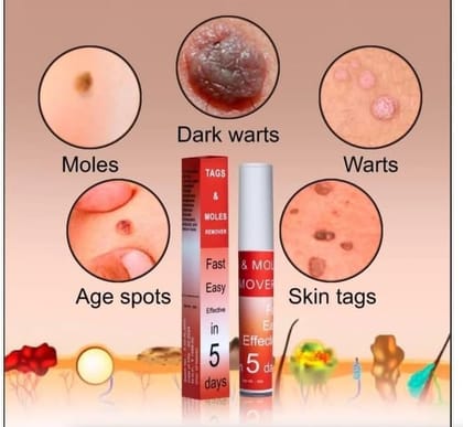 Tags & Moles Remover | Skin Spot Clearing Solution | Gentle Application | Effective Herbal Extract Formula For Face, Body, Neck, Armpit, Restore Skin Health and Beauty (2)