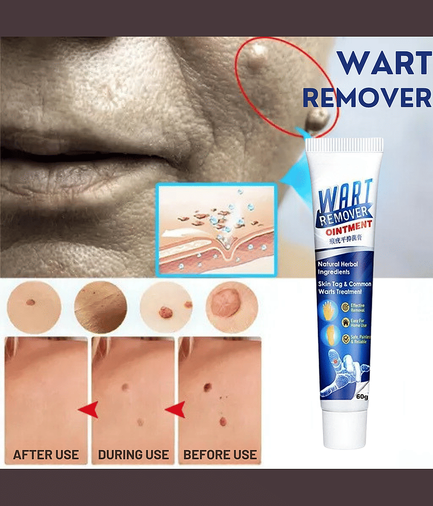 Wart Removal Ointment Treatment for Remove Warts Moles & Acne Safely Painless