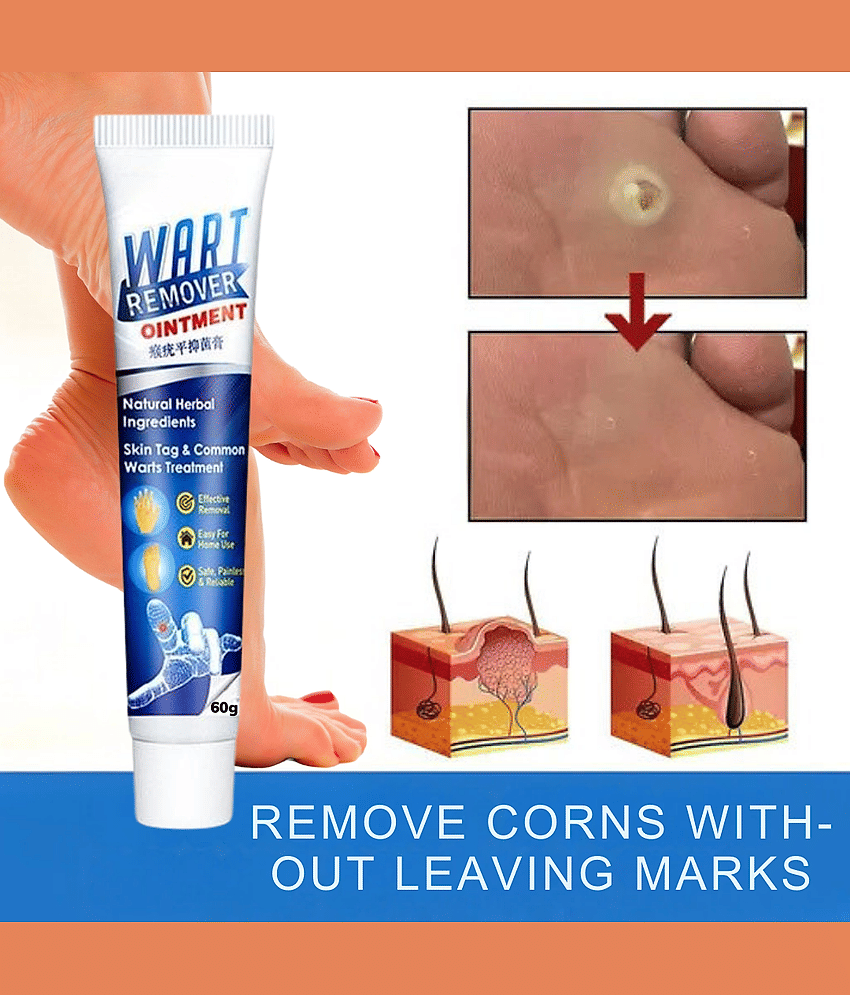 Wart Removal Ointment Treatment for Remove Warts Moles & Acne Safely Painless