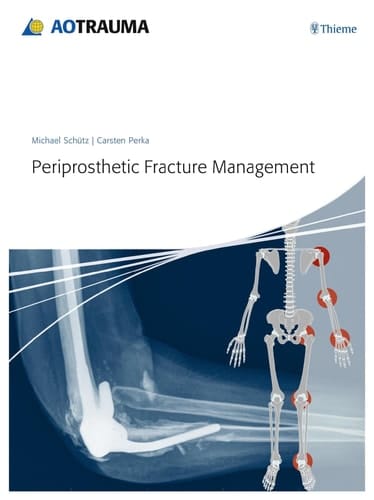 Aotrauma: Periprosthetic Fracture Management 1/e